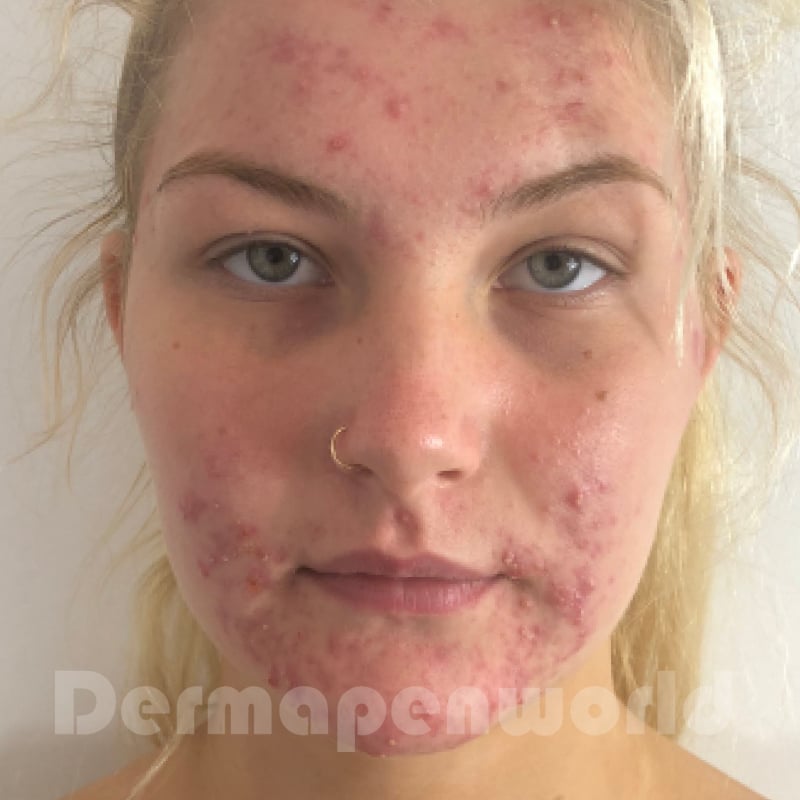 Before-and-After_Acne-1