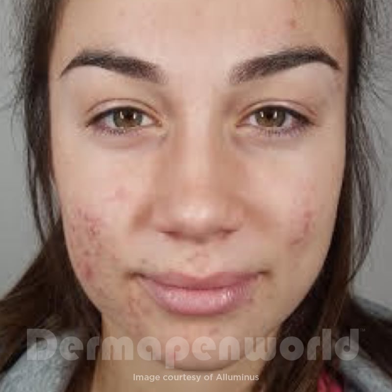 Before-and-After_Acne-5