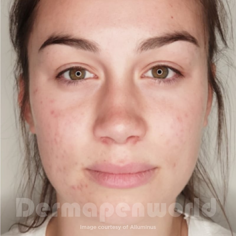 Before-and-After_Acne-6