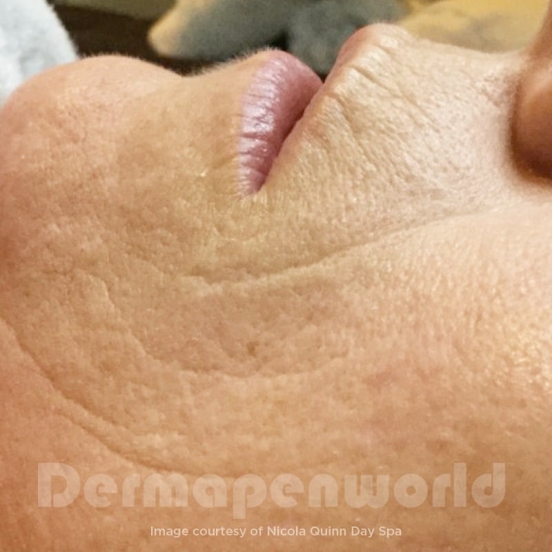 Before-and-After_Enlarged-Pores-6
