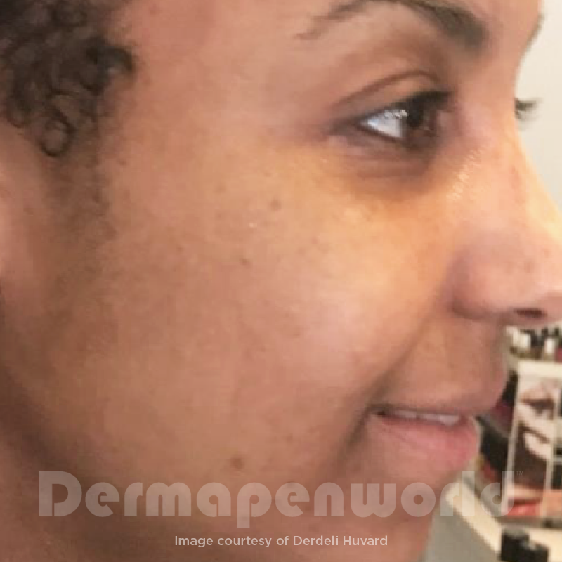 Before-and-After_Pigmentation-10