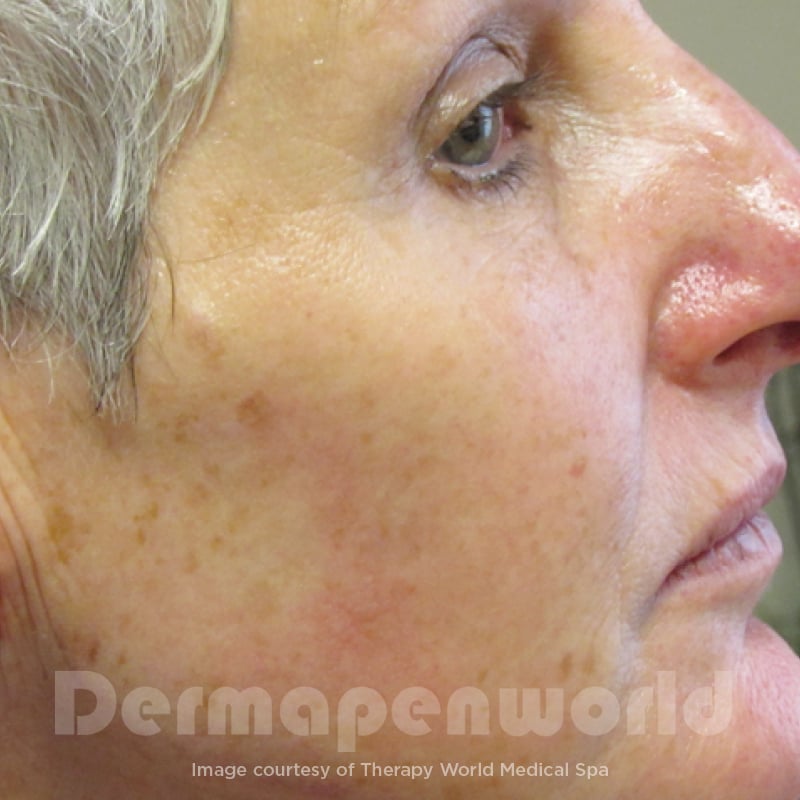 Before-and-After_Pigmentation-2