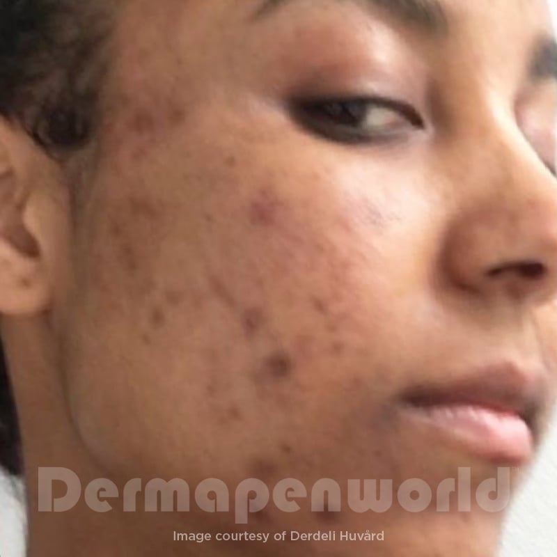 Before-and-After_Pigmentation-9