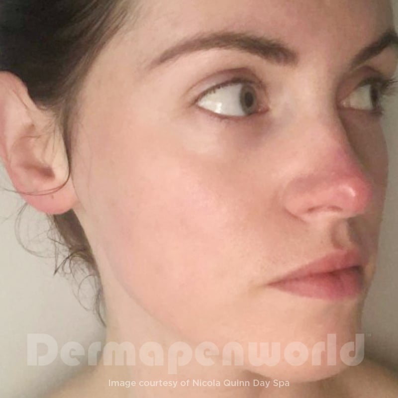Before-and-After_Rosacea-2