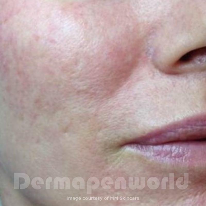 Before-and-After_Rosacea-5