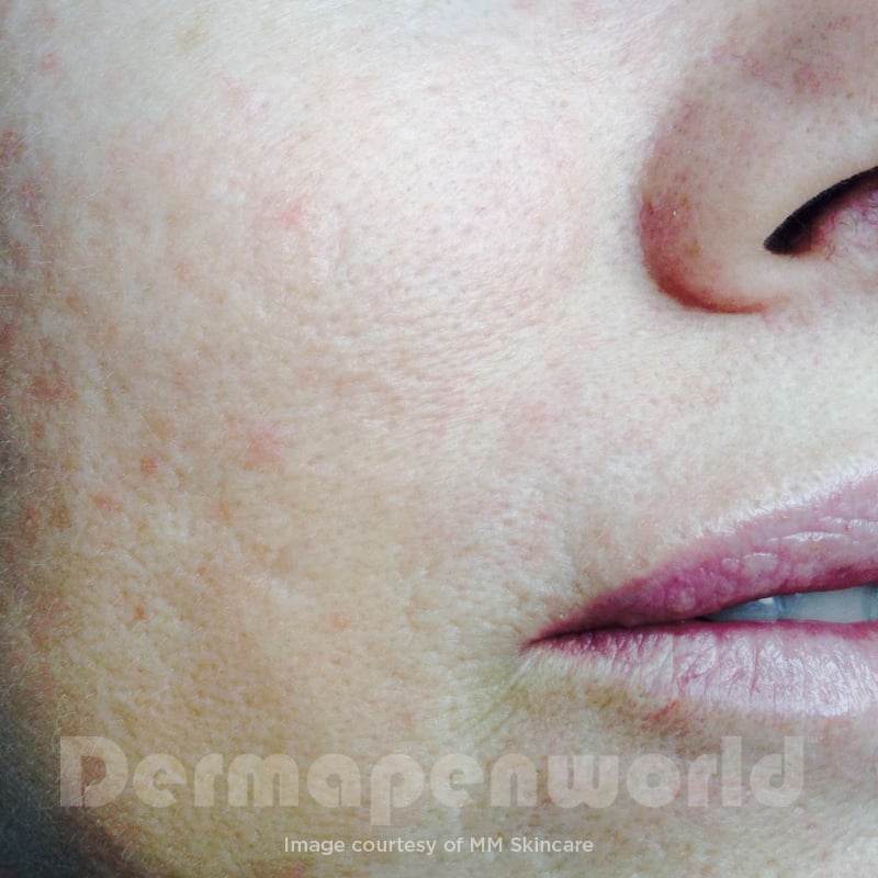 Before-and-After_Rosacea-6