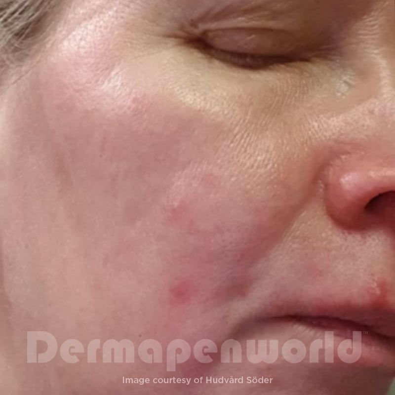Before-and-After_Rosacea-8