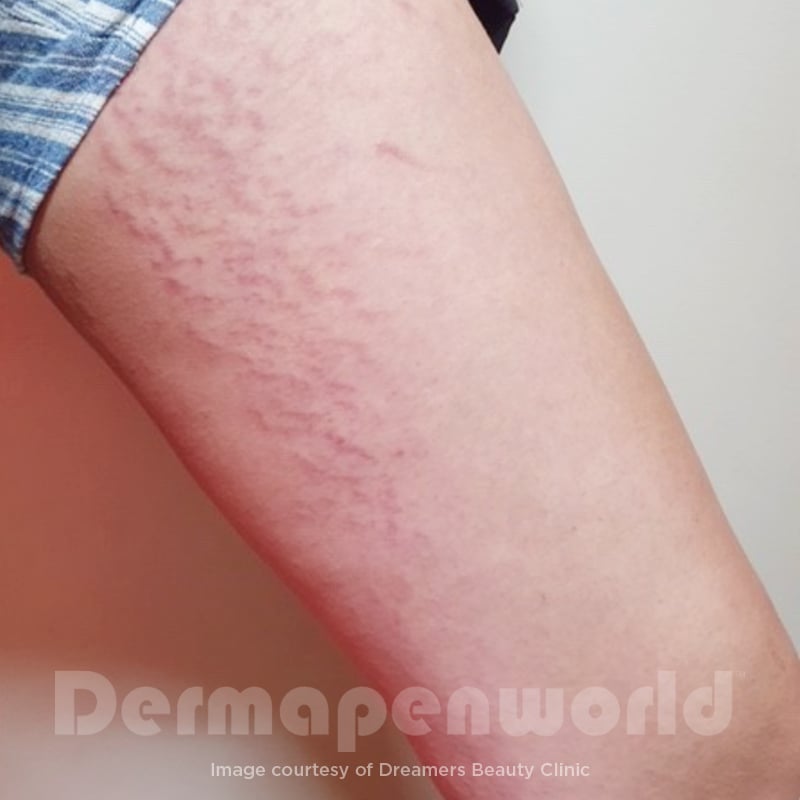 Before-and-After_Stretch-Marks-1