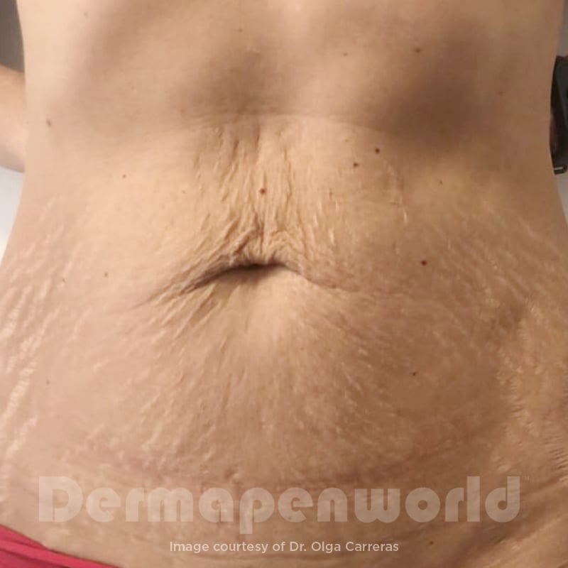 Before-and-After_Stretch-Marks-3