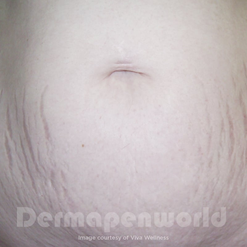 Before-and-After_Stretch-Marks-5