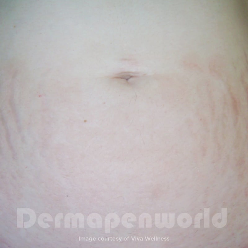 Before-and-After_Stretch-Marks-6